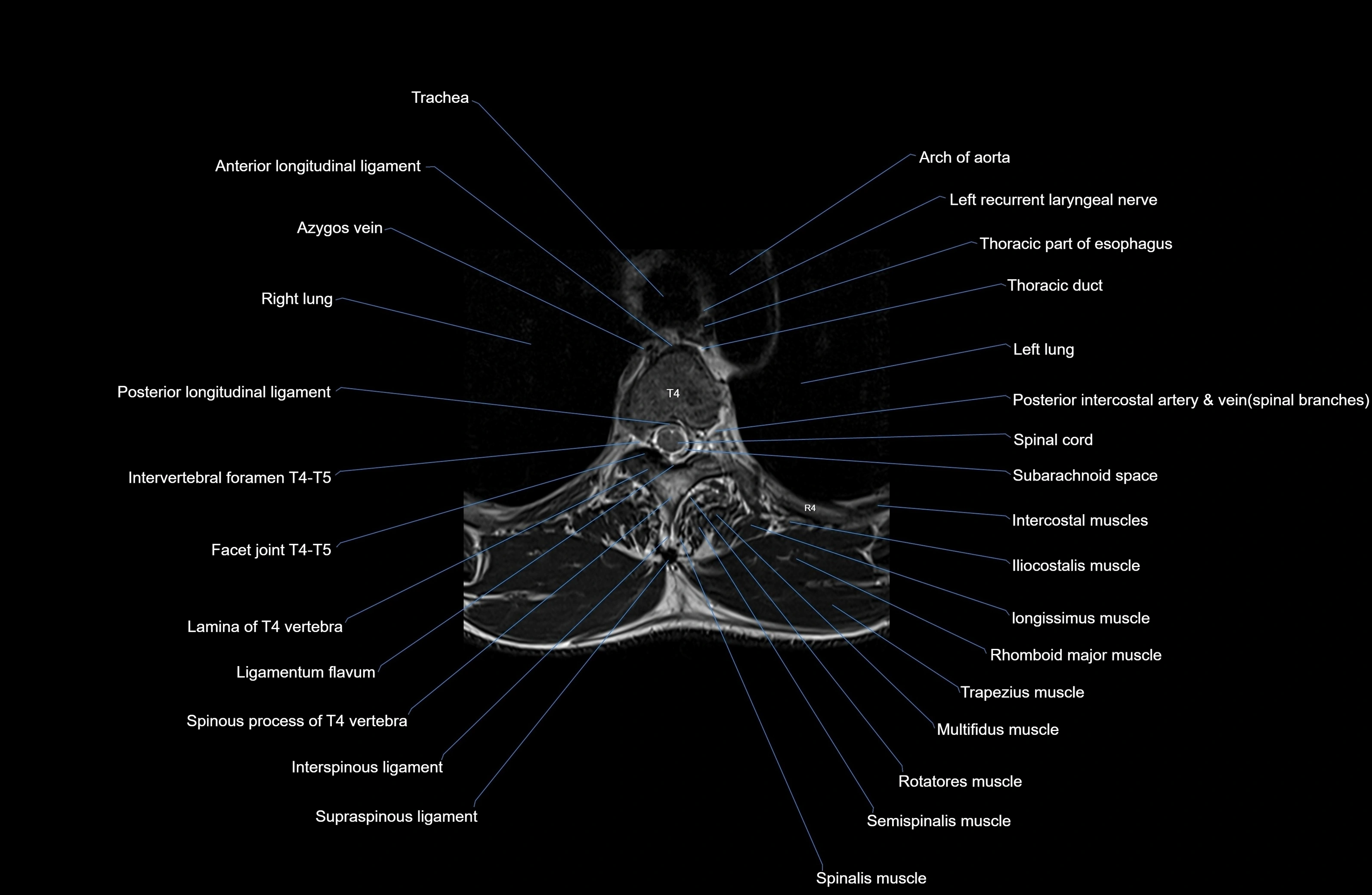 MRI thoracic spine axial  cross sectional anatomy 3T radiology  image-img-00001-00027.webp